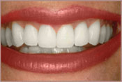 whitening-a